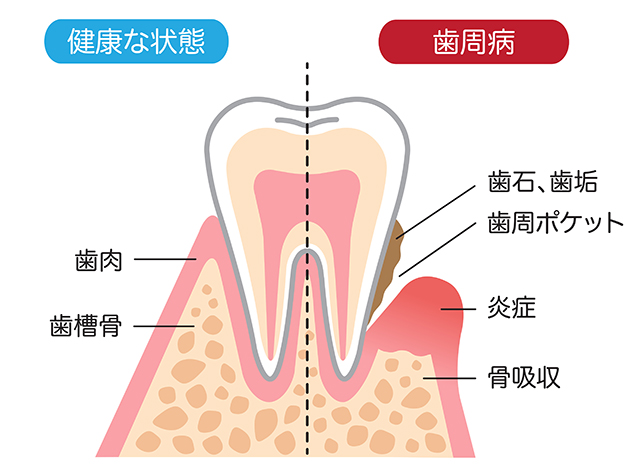 歯を失う原因の第一位が歯周病