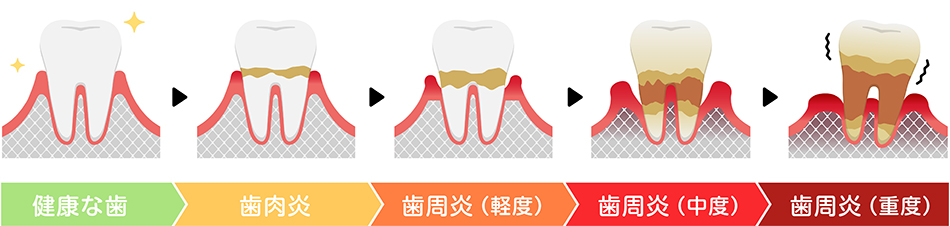 虫歯より怖い？歯周病の恐ろしさ