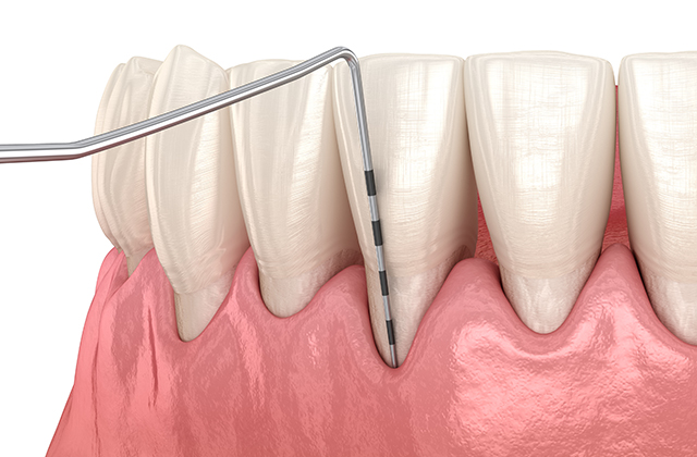 歯周病の検査