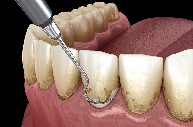 歯ぐきより上の歯垢や歯石の除去